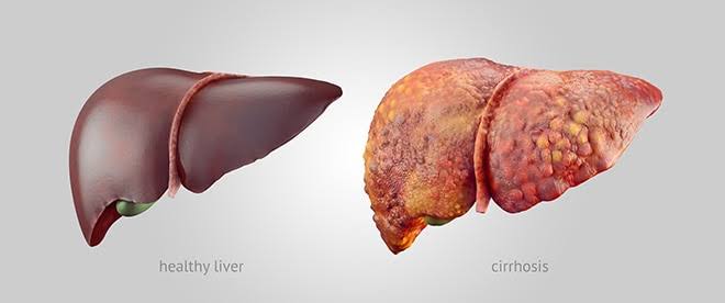 Healthy and Damaged liver